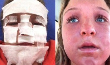 Estuvo 18 minutos en una cama solar y terminó desfigurada: "No tenía límite"