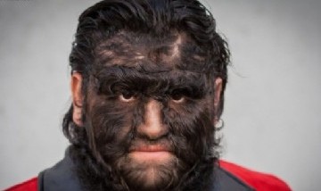 Los verdaderos hombres lobos existen: enteráte de qué se trata la condición sobre el origen de la leyenda