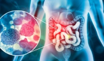 Cáncer de colon: por qué está aumentando la enfermedad entre las personas jóvenes