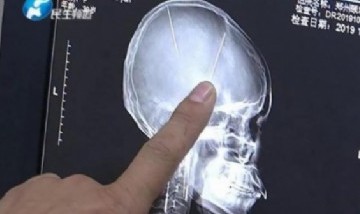 Insólito: Se hizo una tomografía y descubrió que tenía dos agujas en el cerebro
