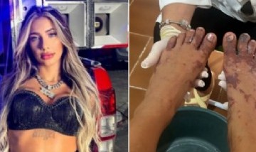 Una influencer brasileña casi pierde los pies por intentar hacer un reto de TikTok