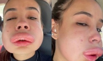 Por colocarse relleno en los labios tuvo una reacción alérgica que le desfiguró la cara