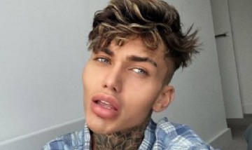 ¿Era necesario? Un chico gastó 40 mil dólares en cirugías para lucir como un filtro de Instagram