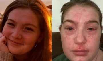 Insólito: una joven asegura ser alérgica a su novio y contó cuáles son los extraños síntomas