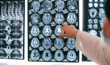 A los 17 años se convirtió en la persona más joven en padecer Alzheimer