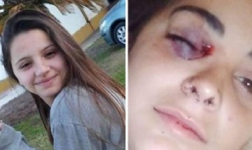 Caso Úrsula: habló la amiga que fue baleada por la Policía cuando pedía justicia