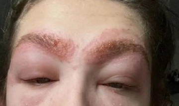 Se tiñó las cejas y sufrió una terrible reacción alérgica que le desfiguró la cara