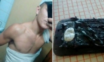 A joven cordobés le explotó el celular mientras dormía y sufrió graves quemaduras en su cuerpo