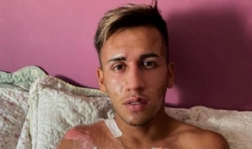 Accidente doméstico produce grandes quemaduras a un jugador de fútbol