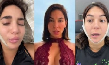 Luciana Milessi sufrió una parálisis facial tras una cirugía estética y procupó a todos