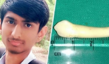 Fue al dentista porque le dolía la boca y le extrajeron el "diente más largo del mundo"