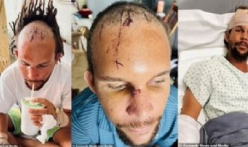 Un cocodrilo le atrapó la cabeza cuando pescaba bajo el agua y logró escapar