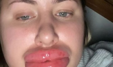 Una joven se rellenó los labios, sufrió una reacción alérgica y se hizo viral